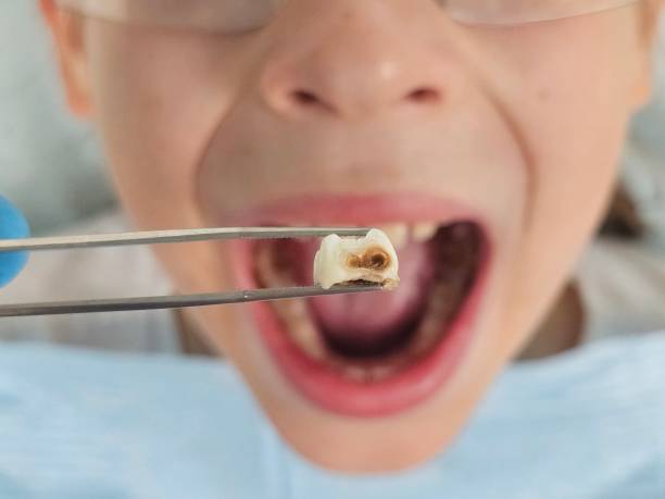 Best Tooth Infection Emergency Dentist  in Bertsch Oceanview, CA